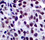 SOX10 Antibody - IHC of Cytokeratin SOX-10 on FFPE Melanoma tissue.