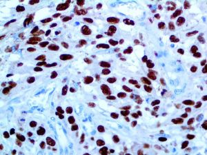 SOX10 Antibody - IHC of SOX-10 on an FFPE Melanoma Tissue