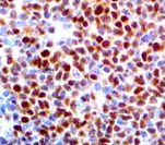 SOX11 Antibody - IHC of SOX-11 on FFPE Mantle Cell Lymphoma tissue. This image was taken for the unmodified form of this product. Other forms have not been tested.