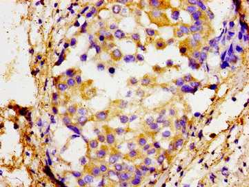 SOX11 Antibody - Immunohistochemistry image of paraffin-embedded human breast cancer at a dilution of 1:100
