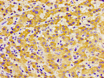 SOX11 Antibody - Immunohistochemistry image of paraffin-embedded human liver cancer at a dilution of 1:100