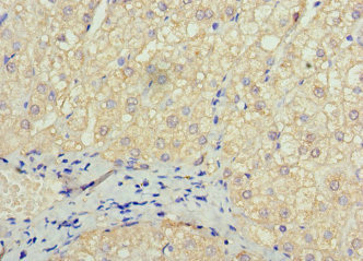 SOX14 Antibody - Paraffin-embedding Immunohistochemistry using human liver cancer at dilution 1:100