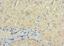 SOX14 Antibody - Paraffin-embedding Immunohistochemistry using human liver cancer at dilution 1:100