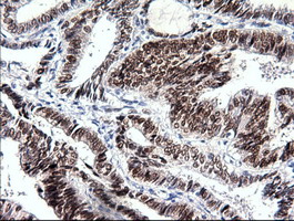 SOX17 Antibody - IHC of paraffin-embedded Adenocarcinoma of ovary tissue using anti-SOX17 mouse monoclonal antibody. (Dilution 1:50).