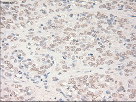 SOX17 Antibody - IHC of paraffin-embedded Carcinoma of bladder tissue using anti-SOX17 mouse monoclonal antibody. (Dilution 1:50).