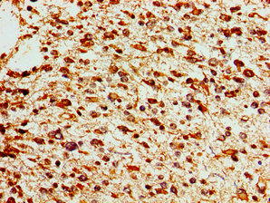 SOX17 Antibody - Immunohistochemistry image of paraffin-embedded human glioma cancer at a dilution of 1:100