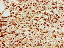 SOX17 Antibody - Immunohistochemistry image of paraffin-embedded human glioma cancer at a dilution of 1:100