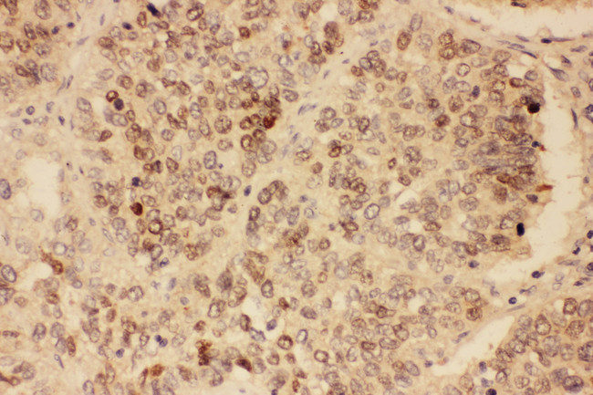 SOX2 Antibody - SOX2 antibody. IHC(P): Human Lung Cancer Tissue.