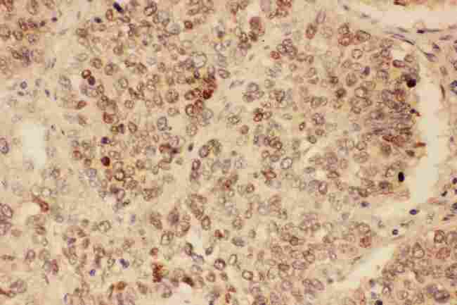 SOX2 Antibody - Anti-SOX2 antibody, IHC(P): Human Lung Cancer Tissue