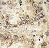 SOX2 Antibody - Formalin-fixed and paraffin-embedded human lung carcinoma tissue reacted with SOX2 antibody , which was peroxidase-conjugated to the secondary antibody, followed by DAB staining. This data demonstrates the use of this antibody for immunohistochemistry; clinical relevance has not been evaluated.