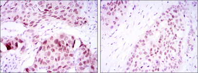 SOX2 Antibody - IHC of paraffin-embedded lung cancer tissues (left) and esophageal cancer tissues (right) using SOX2 mouse monoclonal antibody with DAB staining.