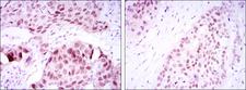 SOX2 Antibody - IHC of paraffin-embedded lung cancer tissues (left) and esophageal cancer tissues (right) using SOX2 mouse monoclonal antibody with DAB staining.