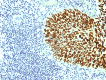 SOX2 Antibody - IHC testing of FFPE human cervical carcinoma with SOX-2 antibody (clone SOX2/1791). Required HIER: boil tissue sections in 10mM citrate buffer, pH 6, for 10-20 min followed by cooling at RT for 20 min.