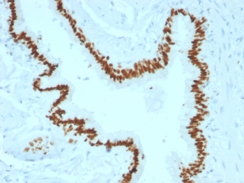 SOX2 Antibody - IHC testing of FFPE human lung carcinoma with SOX-2 antibody (clone SOX2/1791). Required HIER: boil tissue sections in 10mM citrate buffer, pH 6, for 10-20 min followed by cooling at RT for 20 min.