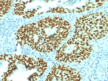 SOX2 Antibody - IHC testing of FFPE human cervical carcinoma with SOX2 antibody (clone SOX2/1792). Required HIER: boil tissue sections in 10mM citrate buffer, pH 6, for 10-20 min followed by cooling at RT for 20 min.