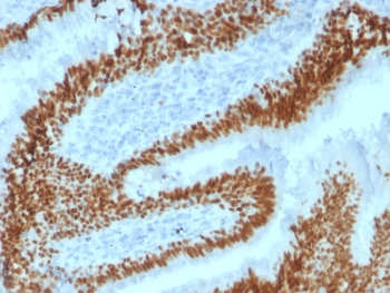 SOX2 Antibody - IHC testing of FFPE human lung carcinoma with SOX2 antibody (clone SOX2/1792). Required HIER: boil tissue sections in 10mM citrate buffer, pH 6, for 10-20 min followed by cooling at RT for 20 min.