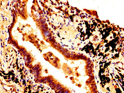 SOX2 Antibody - IHC image of SOX2 Antibody diluted at 1:500 and staining in paraffin-embedded human lung cancer performed on a Leica BondTM system. After dewaxing and hydration, antigen retrieval was mediated by high pressure in a citrate buffer (pH 6.0). Section was blocked with 10% normal goat serum 30min at RT. Then primary antibody (1% BSA) was incubated at 4°C overnight. The primary is detected by a biotinylated secondary antibody and visualized using an HRP conjugated SP system.