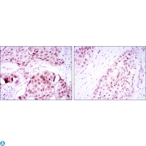 SOX2 Antibody - Immunohistochemistry (IHC) analysis of paraffin-embedded Lung Cancer Tissues (left) and esophageal cancer tissues (right) with DAB staining using SOX-2 Monoclonal Antibody.