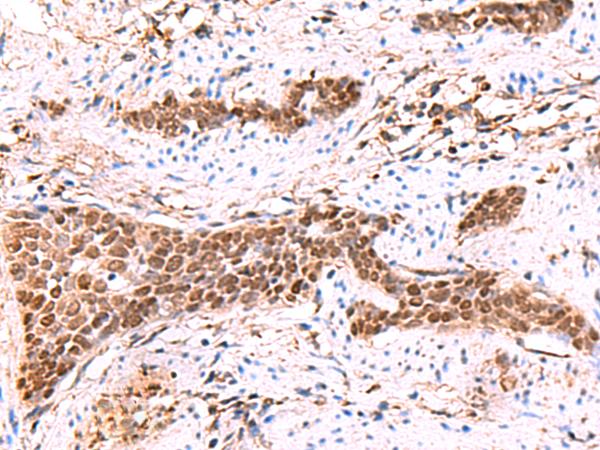 SOX2 Antibody - Immunohistochemistry of paraffin-embedded Human esophagus cancer tissue  using SOX2 Polyclonal Antibody at dilution of 1:35(×200)