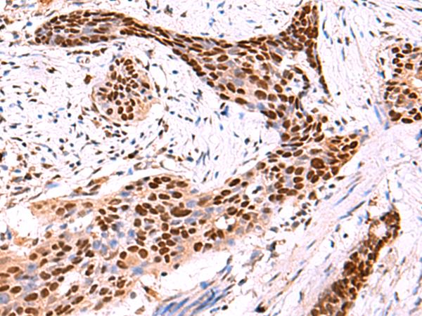 SOX2 Antibody - Immunohistochemistry of paraffin-embedded Human esophagus cancer tissue  using SOX2 Polyclonal Antibody at dilution of 1:50(×200)