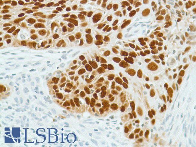 SOX2 Antibody - Immunohistochemistry of Human lung squamous cell carcinoma stained with anti-sox-2 antibody
