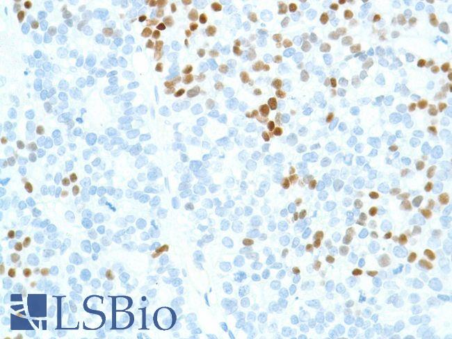 SOX2 Antibody - Immunohistochemistry of Human ovarian adenocarcinoma stained with anti-sox-2 antibody