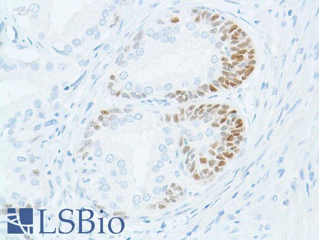 SOX2 Antibody - Immunohistochemistry of Human prostate hyperplasia stained with anti-sox-2 antibody