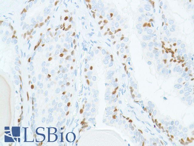 SOX2 Antibody - Immunohistochemistry of Human prostate PIN stained with anti-sox-2 antibody