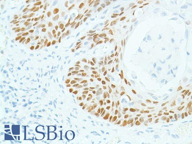 SOX2 Antibody - Immunohistochemistry of Human cervical SCC stained with anti-sox-2 antibody