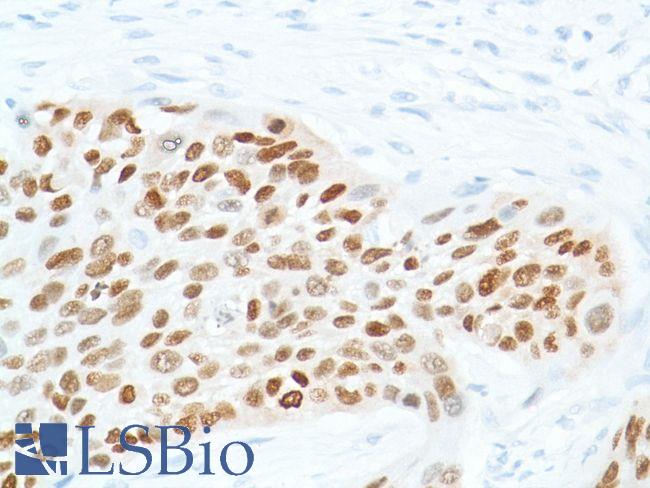 SOX2 Antibody - Immunohistochemistry of Human Esophagus Squamous Cell Carcinoma stained with anti-Sox-2 antibody