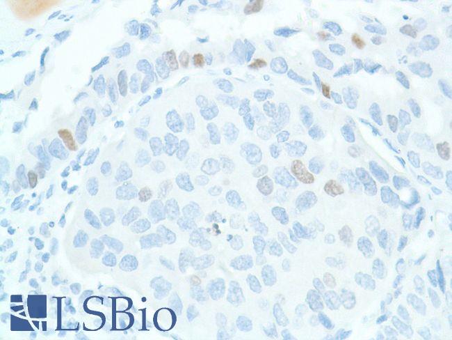 SOX2 Antibody - Immunohistochemistry of Human Bladder TCC stained with anti-Sox-2 antibody