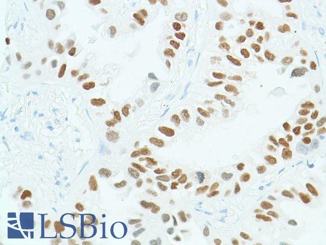 SOX2 Antibody - Immunohistochemistry of Human lung adenocarcinoma stained with anti-sox-2 antibody