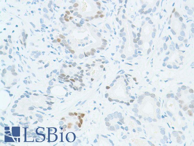 SOX2 Antibody - Immunohistochemistry of Human prostate adenocarcinoma stained with anti-sox-2 antibody