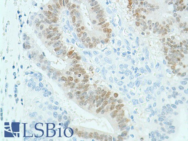 SOX2 Antibody - Immunohistochemistry of Human stomach adenocarcinoma stained with anti-sox-2 antibody