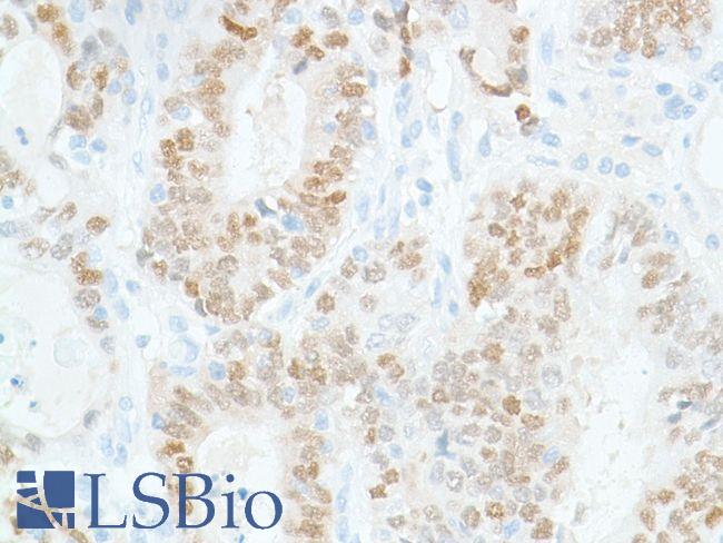 SOX2 Antibody - Immunohistochemistry of Human stomach adenocarcinoma 1 stained with anti-sox-2 antibody