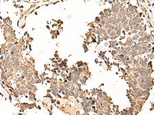 SOX3 Antibody - Immunohistochemistry of paraffin-embedded Human lung cancer tissue  using SOX3 Polyclonal Antibody at dilution of 1:50(×200)