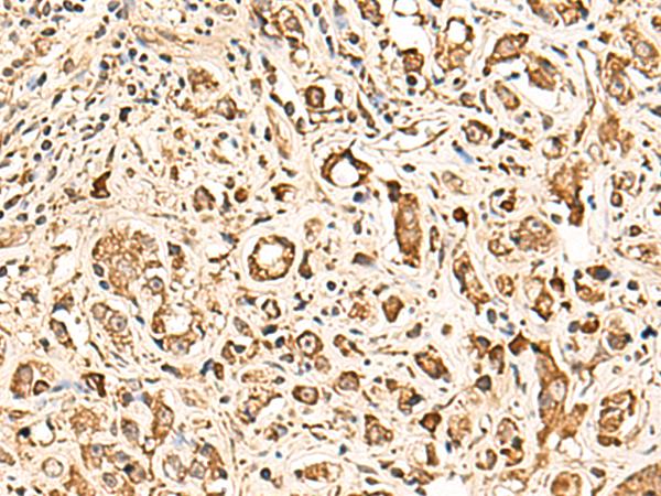 SOX3 Antibody - Immunohistochemistry of paraffin-embedded Human prost ate cancer tissue  using SOX3 Polyclonal Antibody at dilution of 1:50(×200)