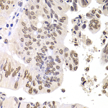 SOX5 Antibody - Immunohistochemistry of paraffin-embedded human colon carcinoma tissue.
