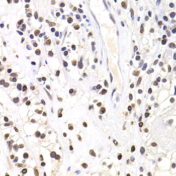 SOX5 Antibody - Immunohistochemistry of paraffin-embedded human kidney cancer tissue.