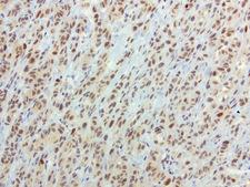 SOX5 Antibody - Immunohistochemical staining of paraffin-embedded human melanoma using anti-SOX5 clone UMAB53 mouse monoclonal antibody  at 1:100 with Polink2 Broad HRP DAB detection kit; heat-induced epitope retrieval with GBI Accel pH 8.7 HIER buffer using pressure chamber for 3 minutes at 110C. Strong nuclear and weak cytoplasmic staining is seen in the tumor cells.