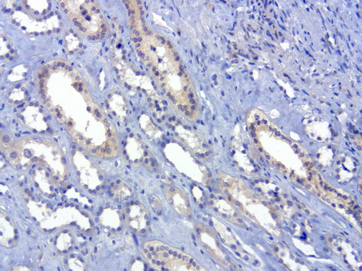 SOX5 Antibody - Immunohistochemical staining of paraffin-embedded human kidney using anti-SOX5 clone UMAB53 mouse monoclonal antibody  at 1:100 with Polink2 Broad HRP DAB detection kit; heat-induced epitope retrieval with GBI Accel pH 8.7 HIER buffer using pressure chamber for 3 minutes at 110C. Weak cytoplasmic staining is seen in the tubule epithelial cells of the kidney.