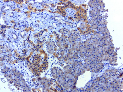 SOX5 Antibody - Immunohistochemical staining of paraffin-embedded human pacreatic cancer using anti-SOX5 clone UMAB53 mouse monoclonal antibody  at 1:100 with Polink2 Broad HRP DAB detection kit; heat-induced epitope retrieval with GBI Accel pH 8.7 HIER buffer using pressure chamber for 3 minutes at 110C. Strong cytoplasmic staining is seen in the tumor cells.