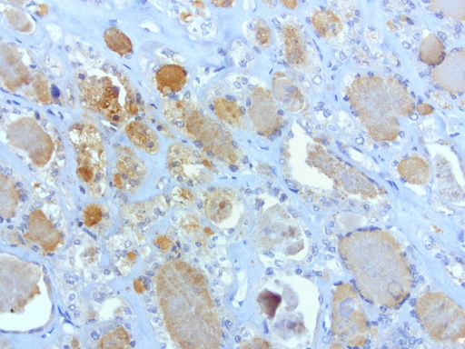 SOX5 Antibody - Immunohistochemical staining of paraffin-embedded human thyroid cancer using anti-SOX5 clone UMAB53 mouse monoclonal antibody  at 1:100 with Polink2 Broad HRP DAB detection kit; heat-induced epitope retrieval with GBI Accel pH 8.7 HIER buffer using pressure chamber for 3 minutes at 110C. Cytoplasmic staining is seen in the tumor cells.