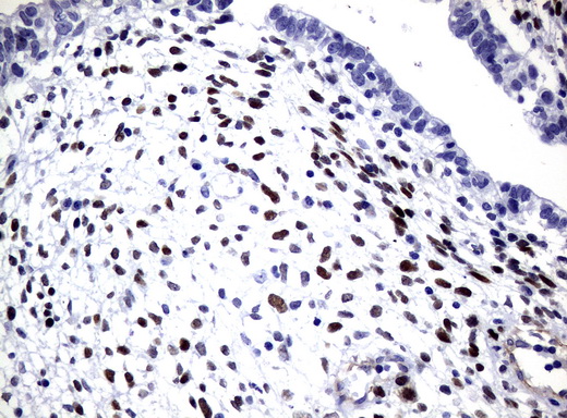 SOX5 Antibody - Immunohistochemical staining of paraffin-embedded Human testicular cancer tissue using anti-SOX5 mouse monoclonal antibody.  heat-induced epitope retrieval by 10mM citric buffer, pH6.0, 120C for 3min)