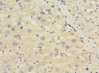 SOX5 Antibody - Immunohistochemistry of paraffin-embedded human liver cancer at dilution 1:100