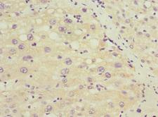 SOX5 Antibody - Immunohistochemistry of paraffin-embedded human liver cancer at dilution 1:100