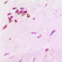 SOX6 Antibody - Immunohistochemical analysis of SOX6 staining in human lung cancer formalin fixed paraffin embedded tissue section. The section was pre-treated using heat mediated antigen retrieval with sodium citrate buffer (pH 6.0). The section was then incubated with the antibody at room temperature and detected using an HRP-conjugated compact polymer system. DAB was used as the chromogen. The section was then counterstained with hematoxylin and mounted with DPX.