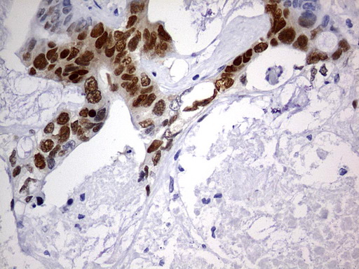 SOX9 Antibody - IHC of paraffin-embedded Adenocarcinoma of Human colon tissue using anti-SOX9 mouse monoclonal antibody. (Heat-induced epitope retrieval by 1 mM EDTA in 10mM Tris, pH9.0, 120°C for 3min).