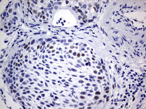 SOX9 Antibody - IHC of paraffin-embedded Carcinoma of Human lung tissue using anti-SOX9 mouse monoclonal antibody. (Heat-induced epitope retrieval by 1 mM EDTA in 10mM Tris, pH9.0, 120°C for 3min).