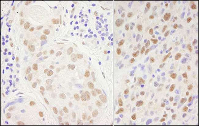 SP1 Antibody - Detection of Human and Mouse SP1 by Immunohistochemistry. Sample: FFPE sections of human breast carcinoma (left) and mouse squamous cell carcinoma (right). Antibody: Affinity purified rabbit anti-Sp1 used at a dilution of 1:1000 (1 ug/ml). Detection: DAB.